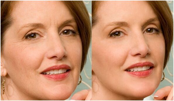 before and after plasma facial skin rejuvenation