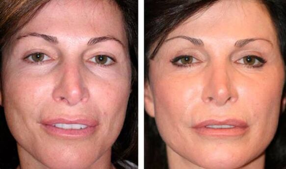 photo before after plasma facial skin rejuvenation