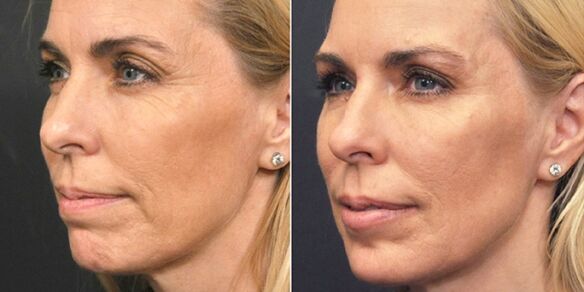 photos before and after plasma rejuvenation