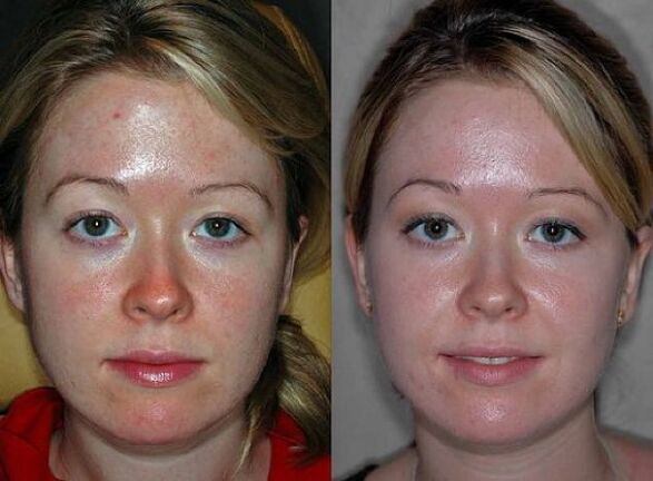 photos before and after the plasma rejuvenation procedure