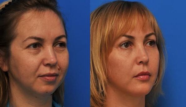 before and after skin rejuvenation with tightening photo 1