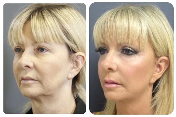 before and after skin rejuvenation with tightening photo 2