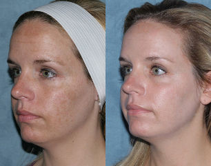 Before and after fractional rejuvenation of the face