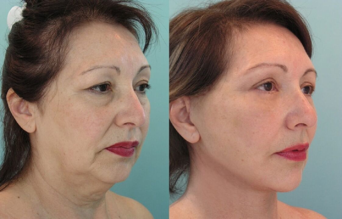 Before and after thread facelift