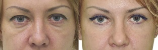 Photos before and after eyelid contouring
