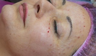 skin restoration after mesotherapy