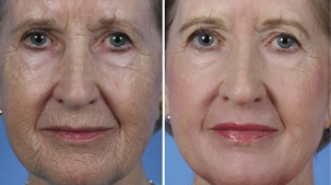 fractional facial rejuvenation before and after photos
