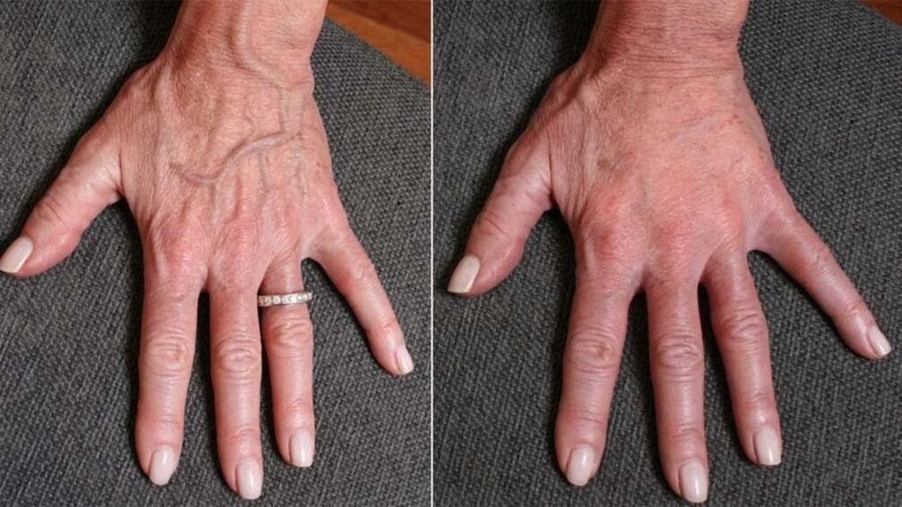 contour plastic, hand rejuvenation photo 1 before and after