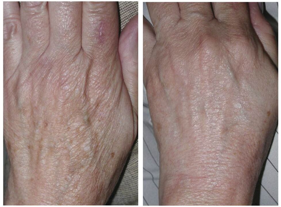 laser rejuvenation of hands before and after photos