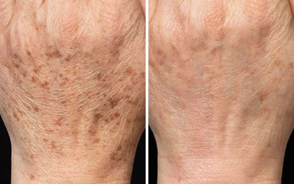 peeling hands before and after photos